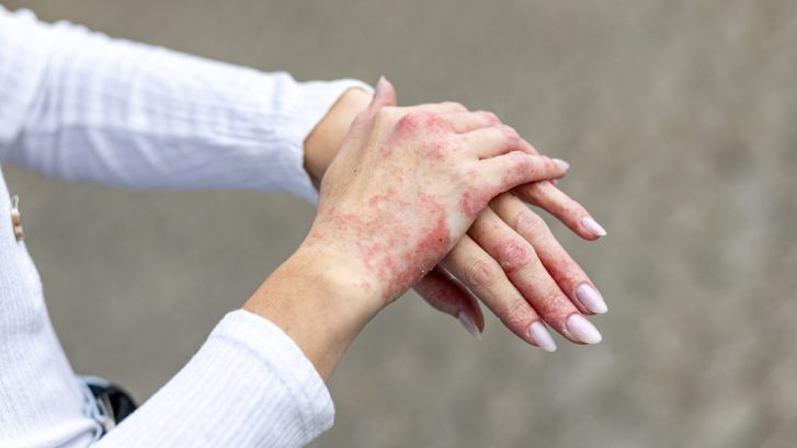 When Is a Dermatologist Appointment for Eczema Treatment Near Chesapeake Beach, MD Necessary?