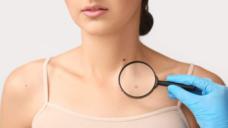 Same-Day Dermatology Appointment for a Suspicious Mole Near Dunkirk MD