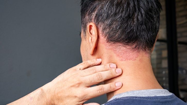 Psoriasis Dermatology Specialist Appointment in North Beach MD