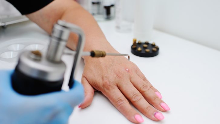 Choosing the Best Dermatologist for a Wart Removal Appointment Near Dunkirk, Maryland