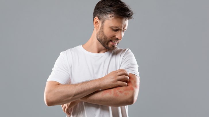 Psoriasis Treatment Near Huntingtown, Maryland: How to Find the Best Dermatologist for Psoriasis