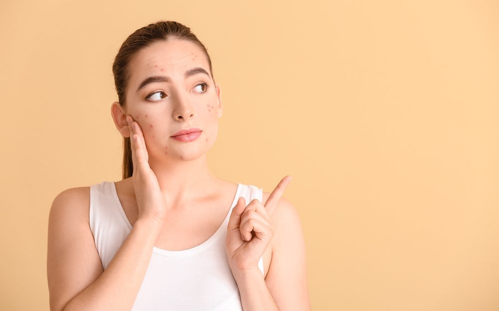 Acne Treatment Near Prince Frederick, Maryland: Find the Best Acne Doctor Accepting New Patients