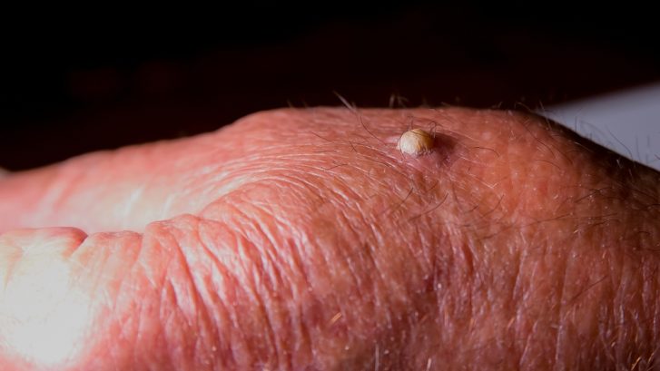 Wart Removal Treatment Near Dunkirk, Maryland: Same-Day Dermatologist Appointment