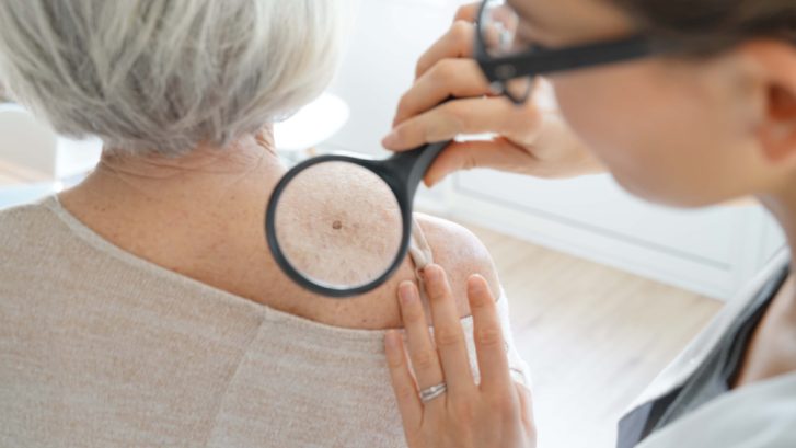 Skin Cancer Treatment Options in Prince Frederick, MD