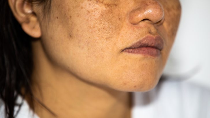 Dermatology Appointments for Hyperpigmentation Treatments in Chesapeake Beach, MD