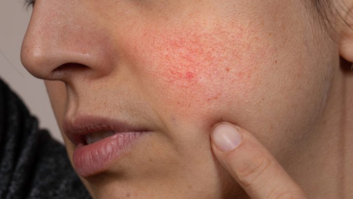 Dermatologist for Rosacea and Facial Redness in Solomons, MD