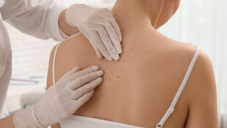 Mohs Surgery Consultations in Prince Frederick, MD