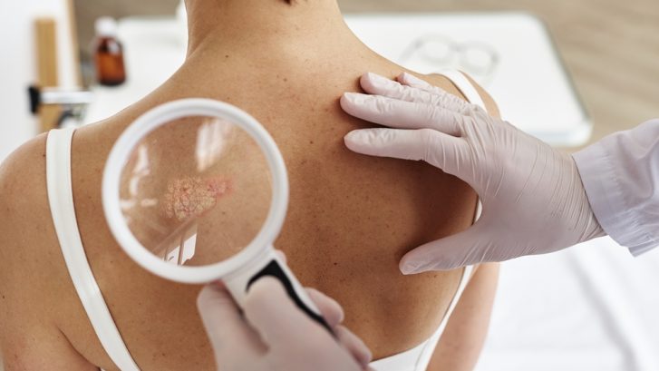 Skin Cancer Screenings in Huntingtown, MD for Early Detection