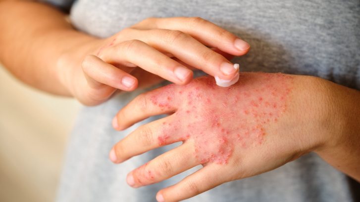 Best Eczema Specialist in Lusby, MD for Chronic Dry Skin Relief