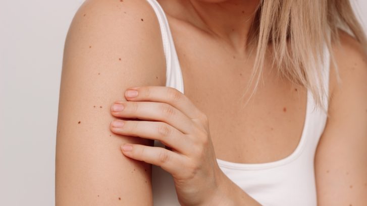 Best Dermatologist Near Calvert County, MD for Suspicious Moles
