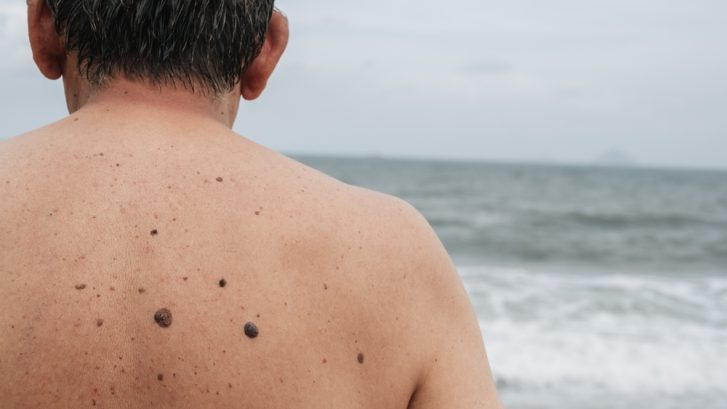 Annual Skin Cancer Checks in North Beach MD