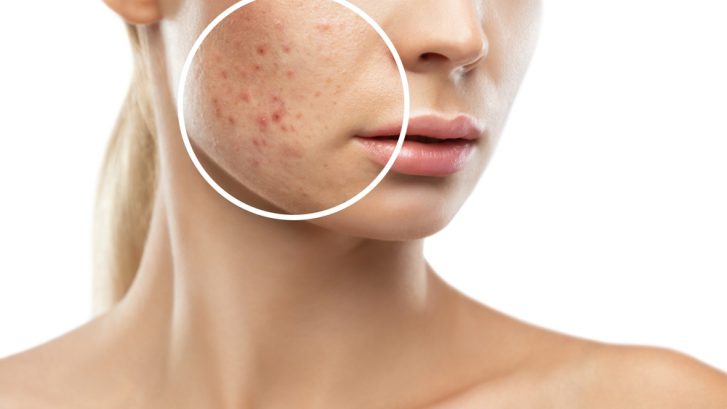 Best Acne Treatment Appointments in Prince Frederick, MD for Adult and Teen Acne
