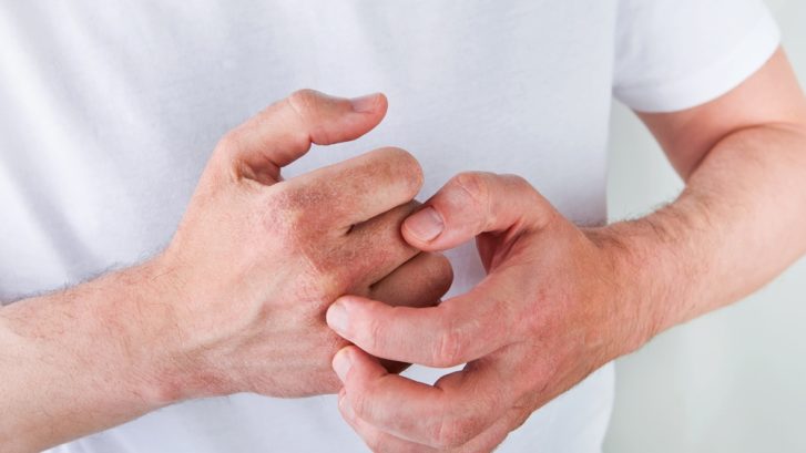 Psoriasis Treatment Options in Huntingtown, MD