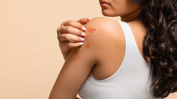 Best Eczema Treatment Near Chesapeake Beach, MD for Dry, Irritated Skin