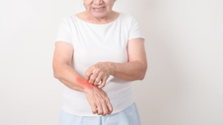 Psoriasis is a chronic autoimmune condition that causes skin cells to build up more quickly than normal, leading to thick, scaly patches that may itch, crack or become uncomfortable.