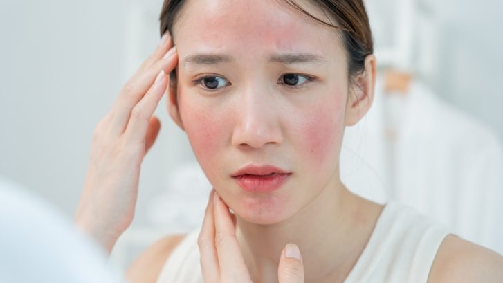 Rosacea Treatment Appointments in Lusby, MD for Facial Redness and Sensitive Skin