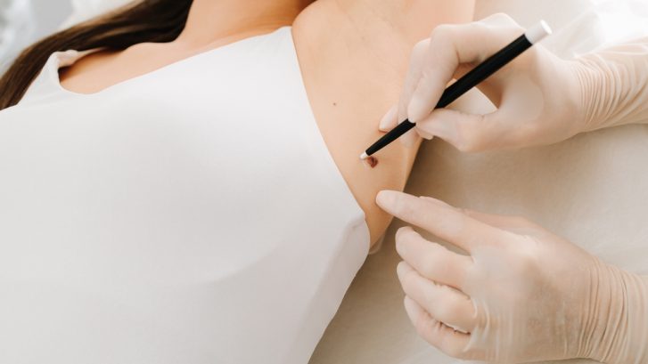 Same-Day Mole Evaluations in Solomons, MD for Changing or Suspicious Skin Lesions