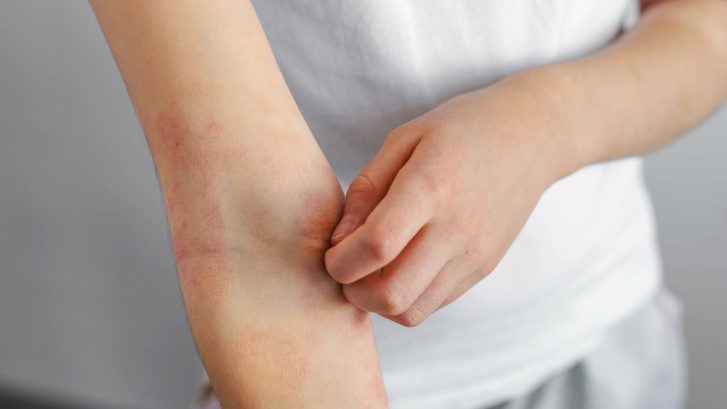 Dermatologist in North Beach, MD for Skin Cancer Screenings, Rashes, and Moles